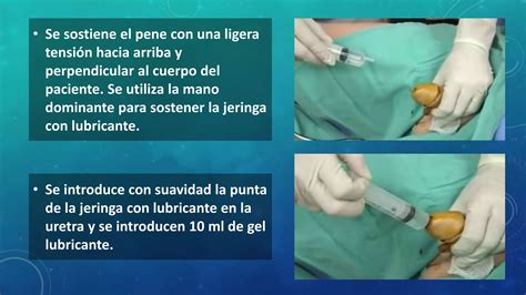 sonda vesical mujer real|Inserción de sondaje vesical temporal o permanente en la mujer ...